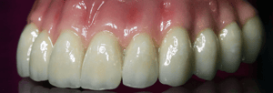 Layered zirconia crown