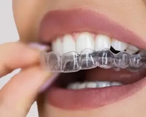 clear retainer 1-1