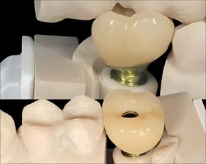 implant crowns1