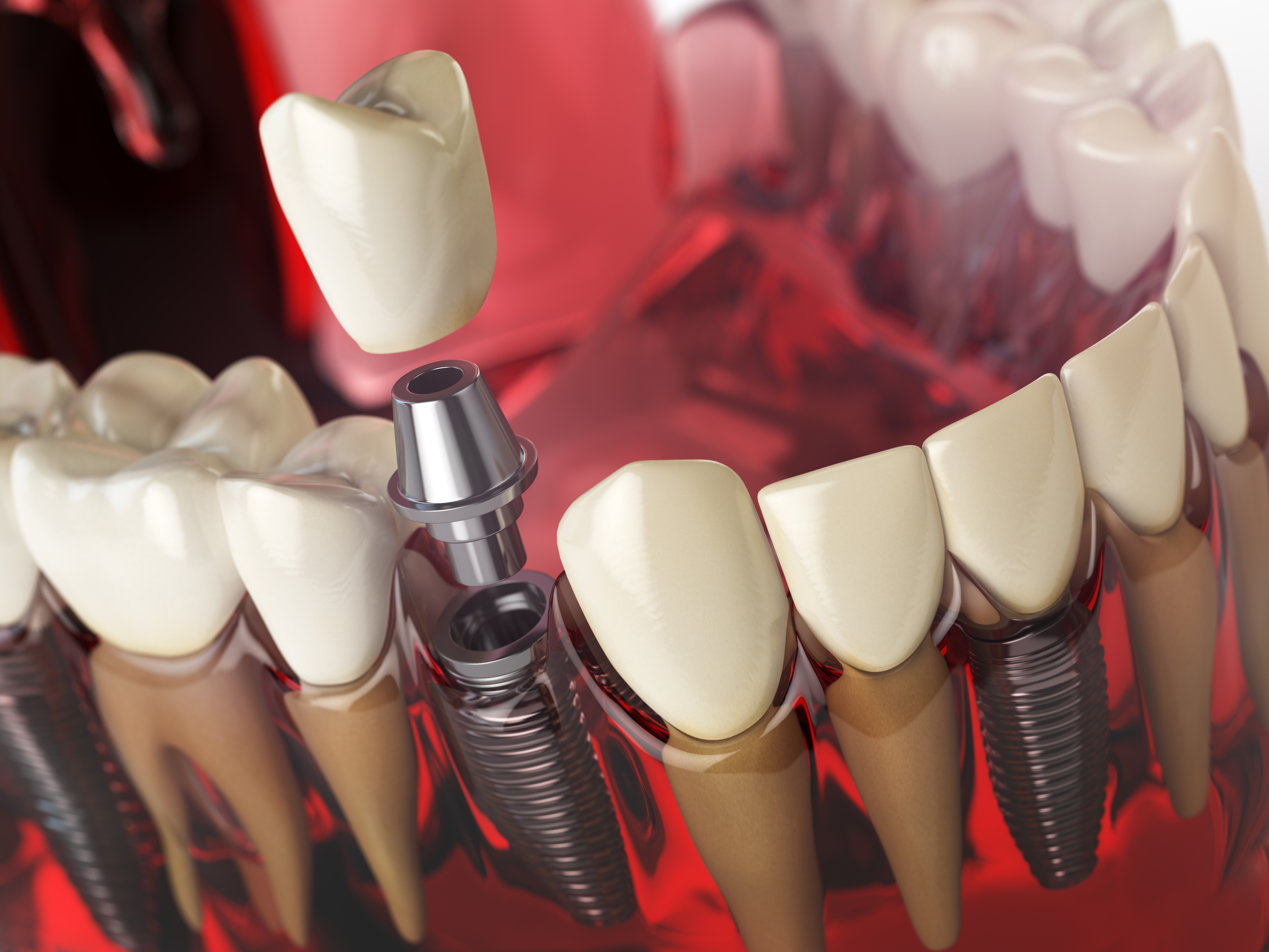 Implant Solutions