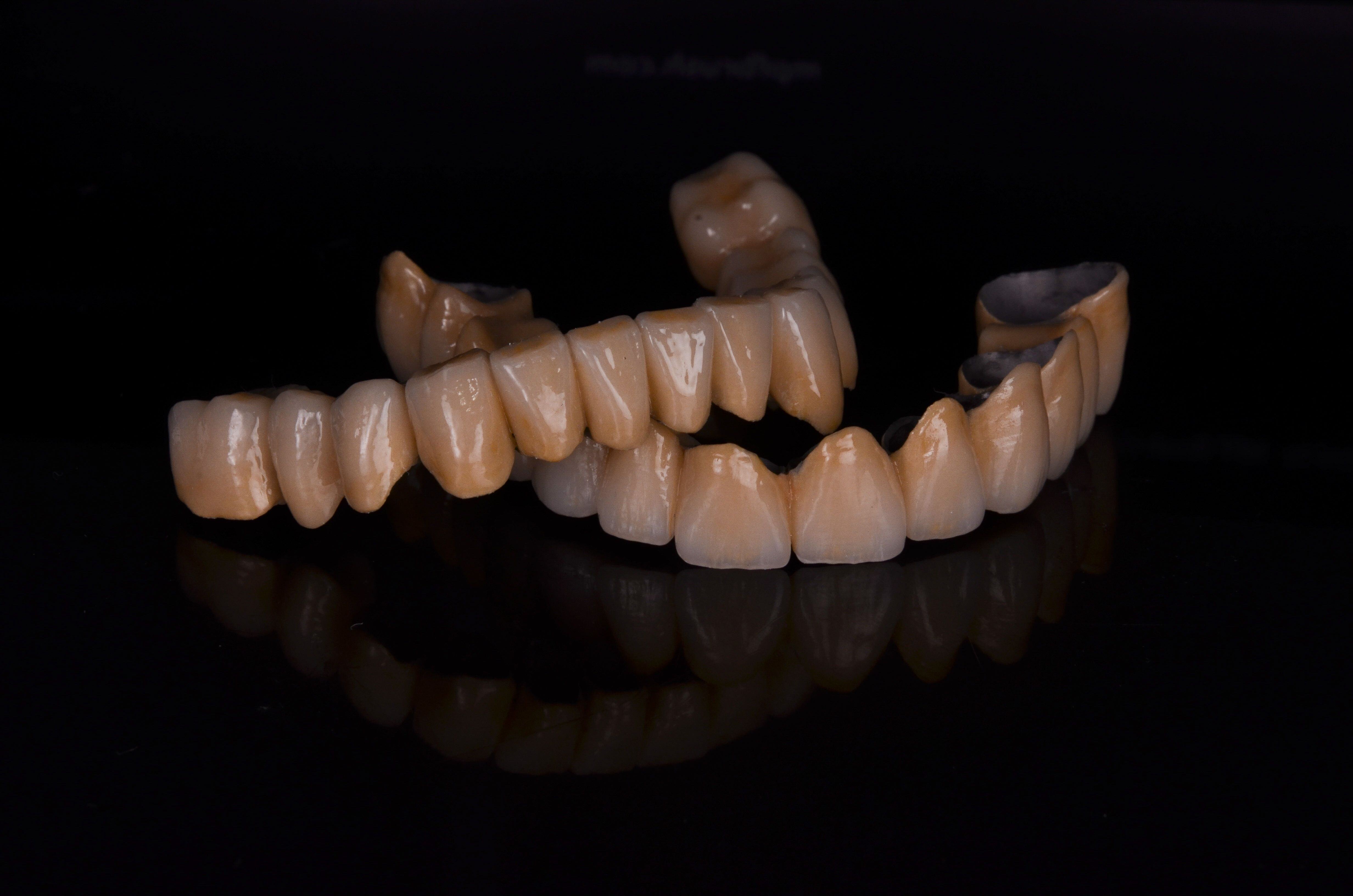 Crowns and Bridge