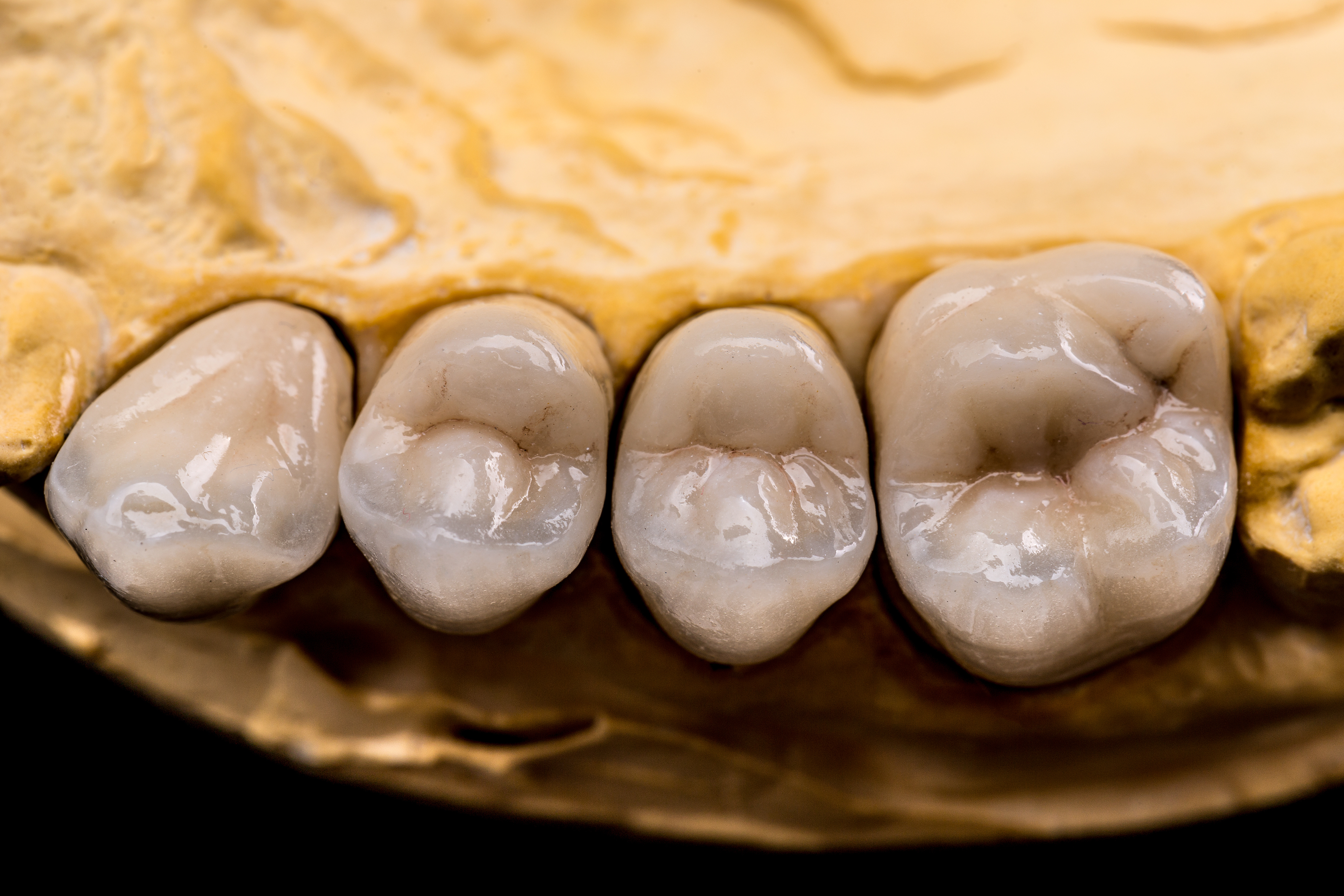 PFM Crowns