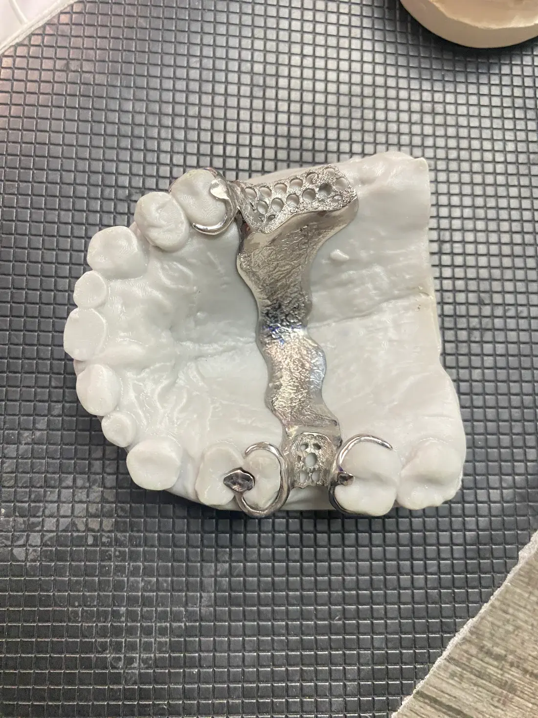 Partial Denture
