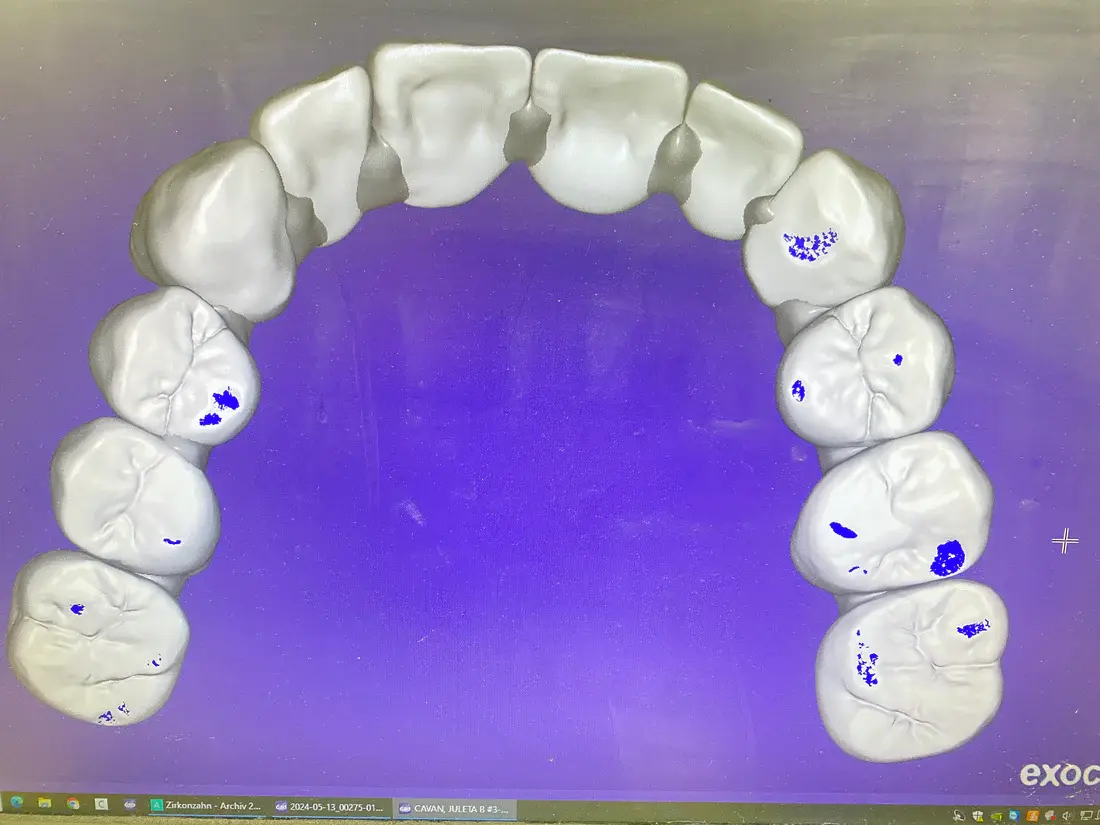Full Zirconia Crowns