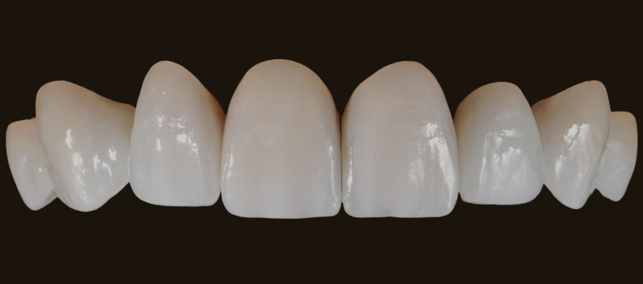 Porcelain veneers anterior arch