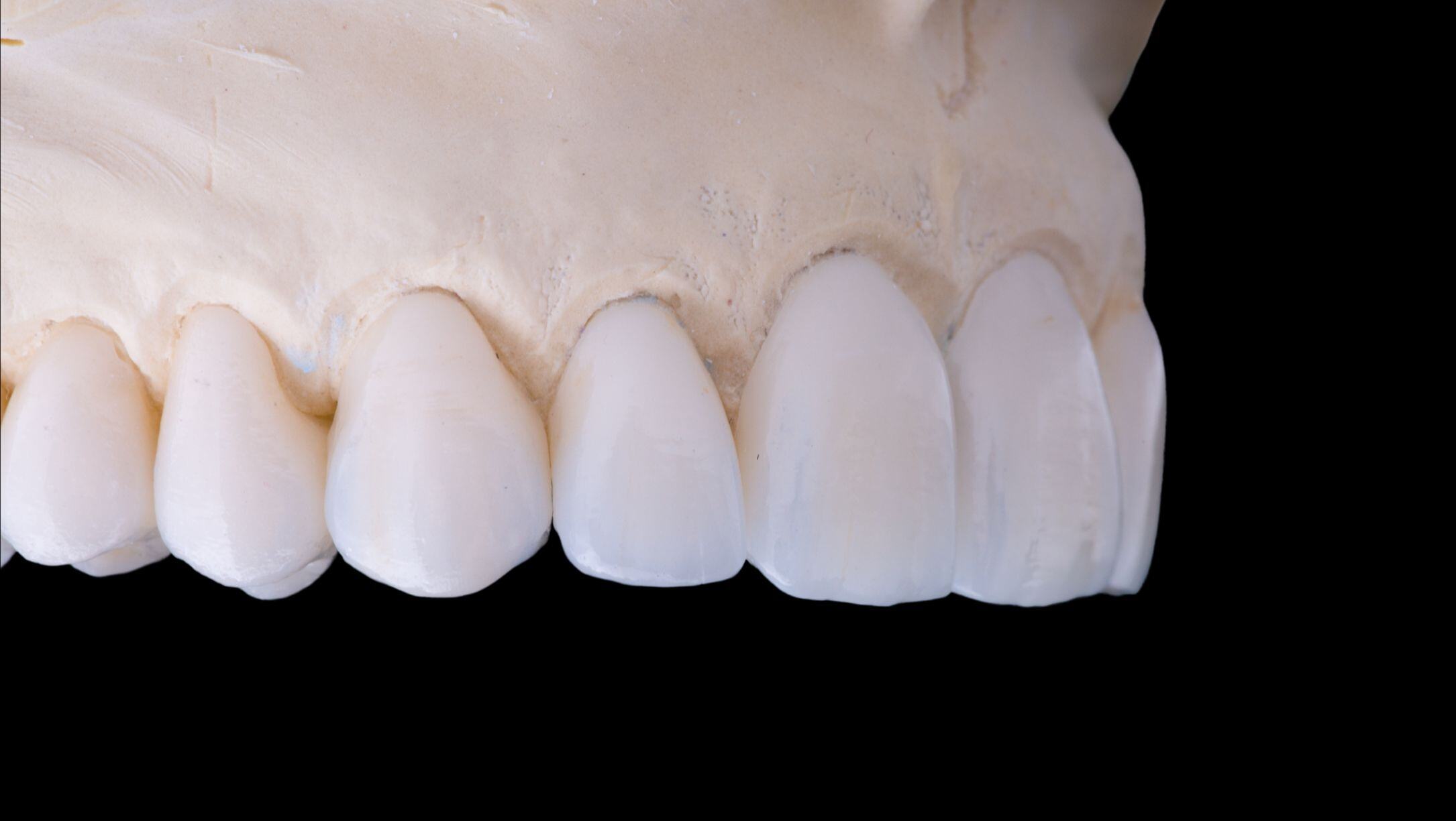 Veneers on plaster dental model