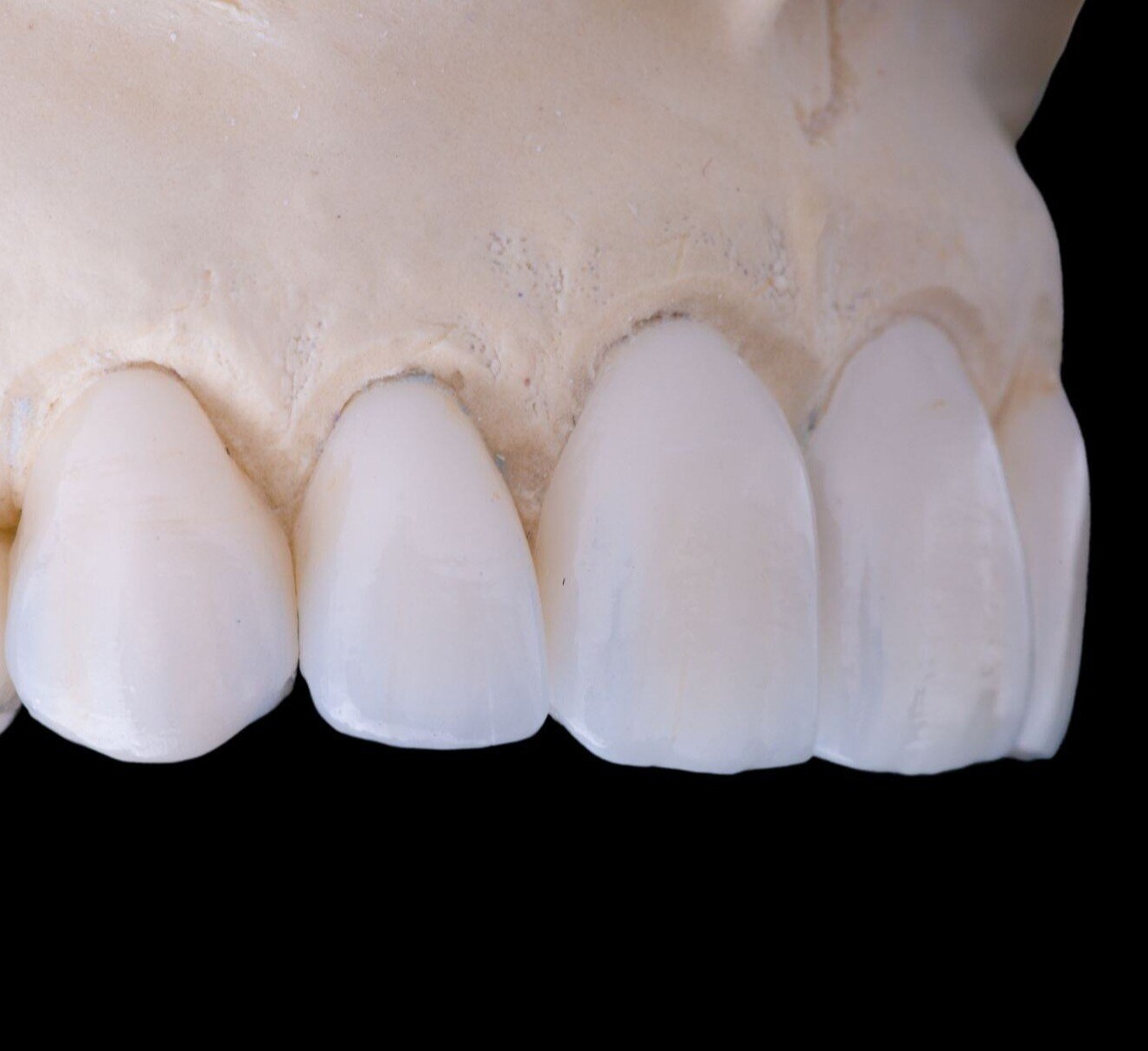 Close-up anterior veneers on model