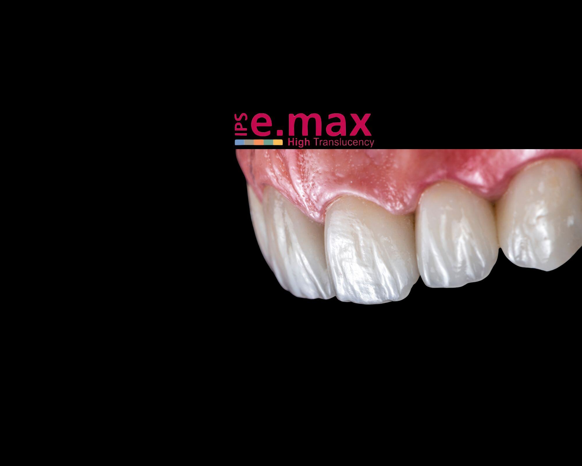 IPS e.max restoration